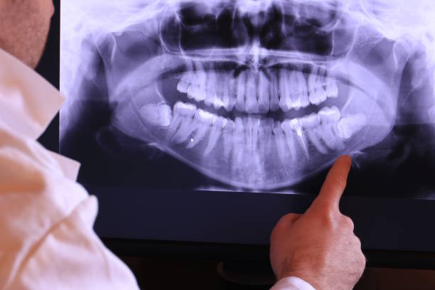 Best Knocked-Out Tooth (Avulsed Tooth) Treatment in Calumet, PA